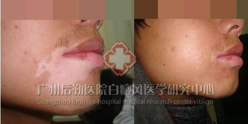 °×ñ°·çÖÕÓÚÖκÃÁË